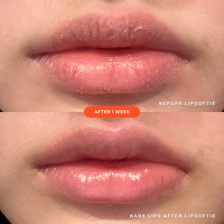 [A before and after image of the same lips showcasing the effectiveness of Tower 28 Beauty's LipSoftie™ Lip Treatment in SOS Vanilla after one week of use]